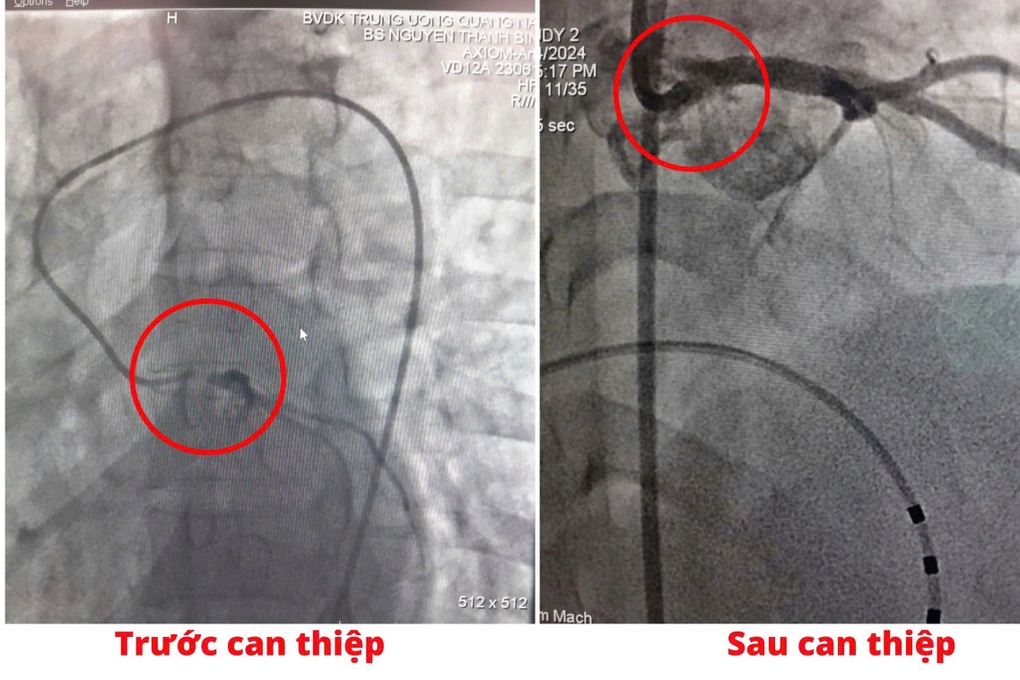 Cứu sống nữ bệnh nhân nhồi máu cơ tim cấp - 1